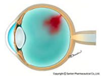 Ill diabeticretinopathy1
